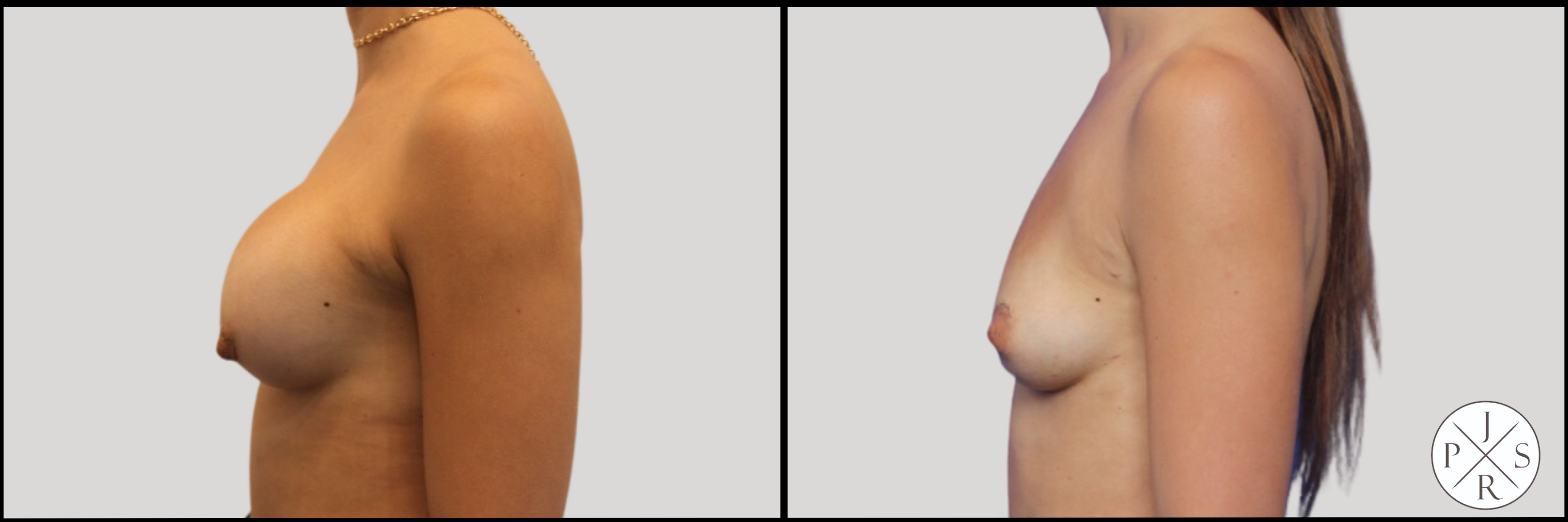 Breast Implant Removal Before & After Image